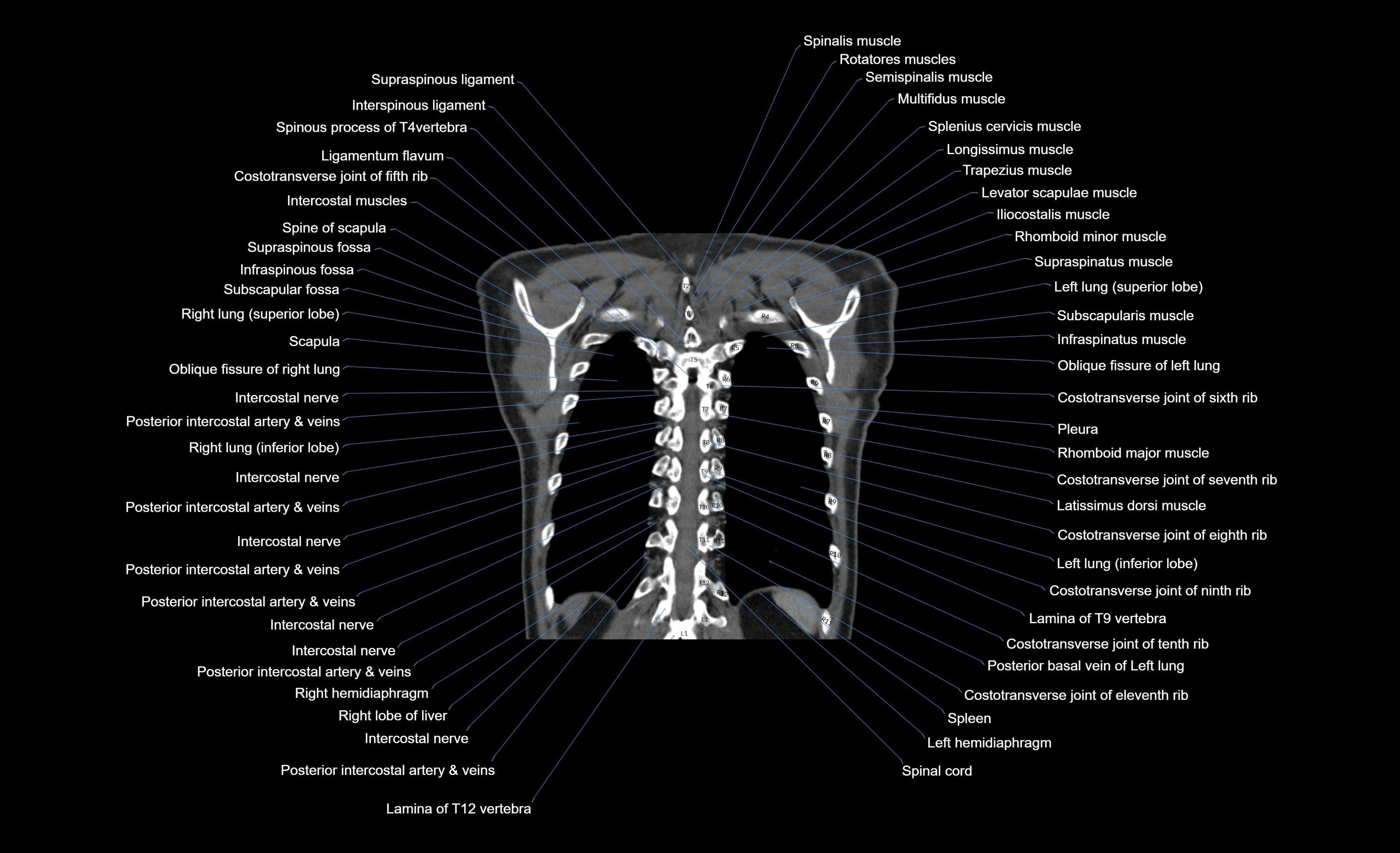 CT chest (thorax) soft tissue window labelled coronal cross sectional anatomy radiology image-00023.webp